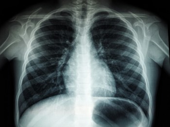 An X-ray of a chest
